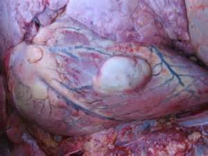 Myocardial Abscess: Abscess on the Heart